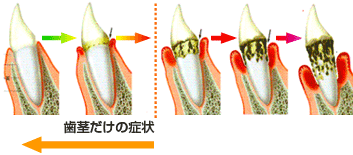 歯周病